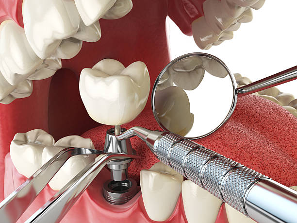 Best Emergency Dentist for Lost Fillings or Crowns in Inglenook, CT